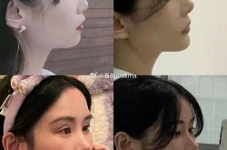 玻尿酸隆鼻效果能维持多久？有没有不良副作用？