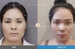 削骨瘦脸价格贵吗？有没有风险？