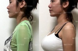 美容丰胸方法众多，哪种效果最自然？
