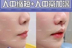 颌面整形术后恢复需要注意什么？怎样缩短恢复期？
