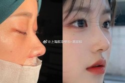 鼻翼沟整形手术怎么做？效果自然吗？