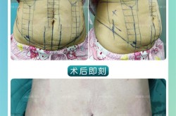 腹壁整形手术复杂吗？恢复期需要多久？