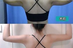 360度环形吸脂减肥效果如何？有没有风险？