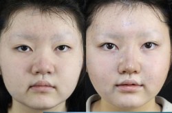鼻头鼻翼整形多少钱？手术风险与效果如何？