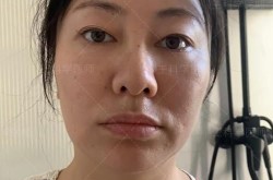 眼袋抽脂手术有风险吗？术后如何护理？