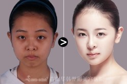 女人整形前后有哪些变化？如何选择整形项目？