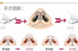 鼻头整形价格区间大吗？手术效果能维持多久？