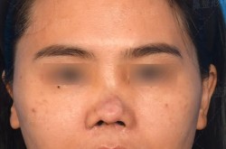 全鼻再造术的手术过程复杂吗？恢复期多久？