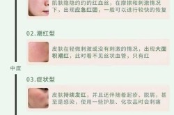 去红血丝偏方有效吗？医学美容方法又有哪些？
