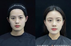 额头窄颧骨高怎么办？有哪些整形方法可以改善？