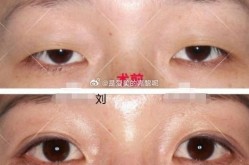 双眼皮北京哪家医院做得最自然？手术过程复杂吗？