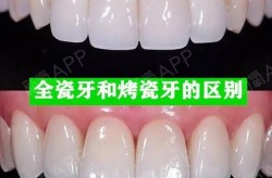 做一颗烤瓷牙多少钱？不同材料的差异？