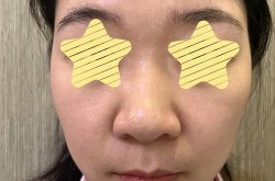 鼻翼整形的价格和手术方式有关吗？哪种方式最好？