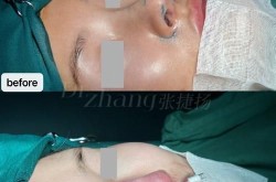 鼻小柱整形效果自然吗？有哪些手术方法？