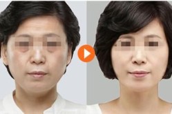 自体脂肪丰下巴的费用是多少？效果持久吗？