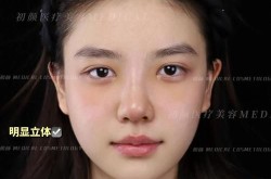 鼻子综合整形手术复杂吗，恢复期多久？