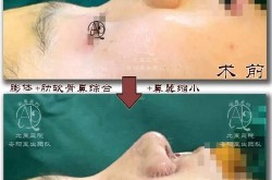 韩式鼻部整形术多少钱？韩式鼻整形和传统鼻整形哪个好？