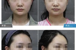 颌面手术风险大吗？术后恢复需要注意什么？