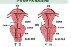 女人下面肥大馒头一样可以整形吗？有哪些手术方法？