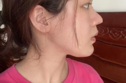 鼻尖美容术多少钱？效果能维持多久？
