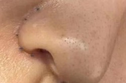 鼻翼缩小手术有哪些方法？术后护理需要注意什么？
