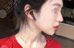 鼻翼缩小整容手术安全吗？恢复期需要多久？