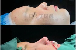 膨体硅胶隆鼻哪种更自然？价格差别大吗？