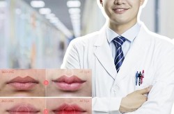 唇部整形服务包括哪些项目，安全吗？