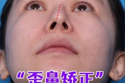 歪鼻梁整形手术复杂吗？恢复期要注意什么？
