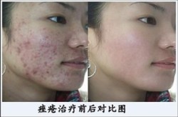 治疗痤疮哪家医院最专业，有没有成功案例？