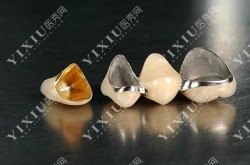 钛合金烤瓷牙的寿命有多长？护理需要注意什么？