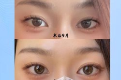 全切双眼皮价格贵不贵？恢复期多久？