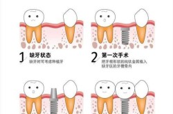 一口假牙的价格是多少？种植过程复杂吗？