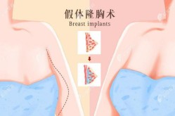 专业假体隆胸术有哪些优点？手术过程复杂吗？