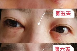整形眼袋手术安全吗？有没有后遗症？