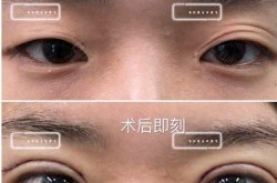 割双眼皮前后对比图曝光，整形真的能改变命运？