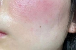 怎么消除红血丝？有没有天然方法？