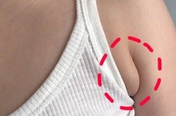 副乳切除手术风险大吗？有哪些注意事项？