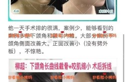 下颌角磨骨整形手术安全吗？恢复期要多久？