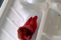 拔智齿一颗牙多少钱？过程痛苦吗？