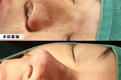 鹰钩鼻整形要多少钱？术后怎么护理？