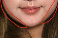 去颊脂垫手术的风险大吗？如何避免术后并发症？