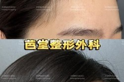额头整形手术多少钱？效果自然吗？