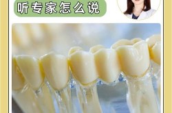 烤瓷牙价格和种类繁多，如何选择最适合自己的？