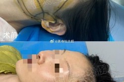 面部拉皮手术价格多少？拉皮手术效果怎么样？