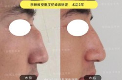 驼峰鼻矫正方法有哪些？手术风险大吗？