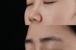玻尿酸隆鼻对比图可以看出哪些变化？有没有风险？