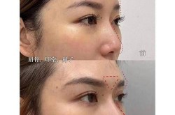 胶原蛋白隆鼻价格是多少？效果好吗？