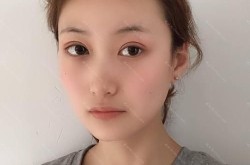 伊美尔健翔医院做双眼皮手术怎么样？安全吗？