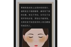 华南黄褐斑特诊中心怎么样？有哪些治疗方法？